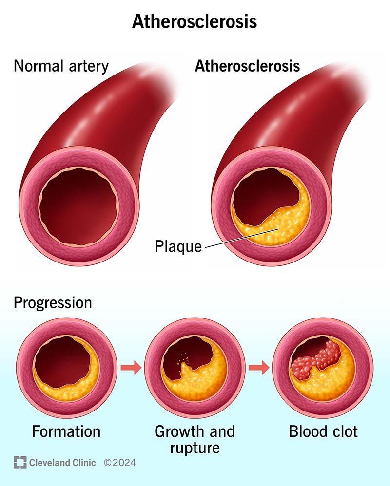 Atherosclerosis